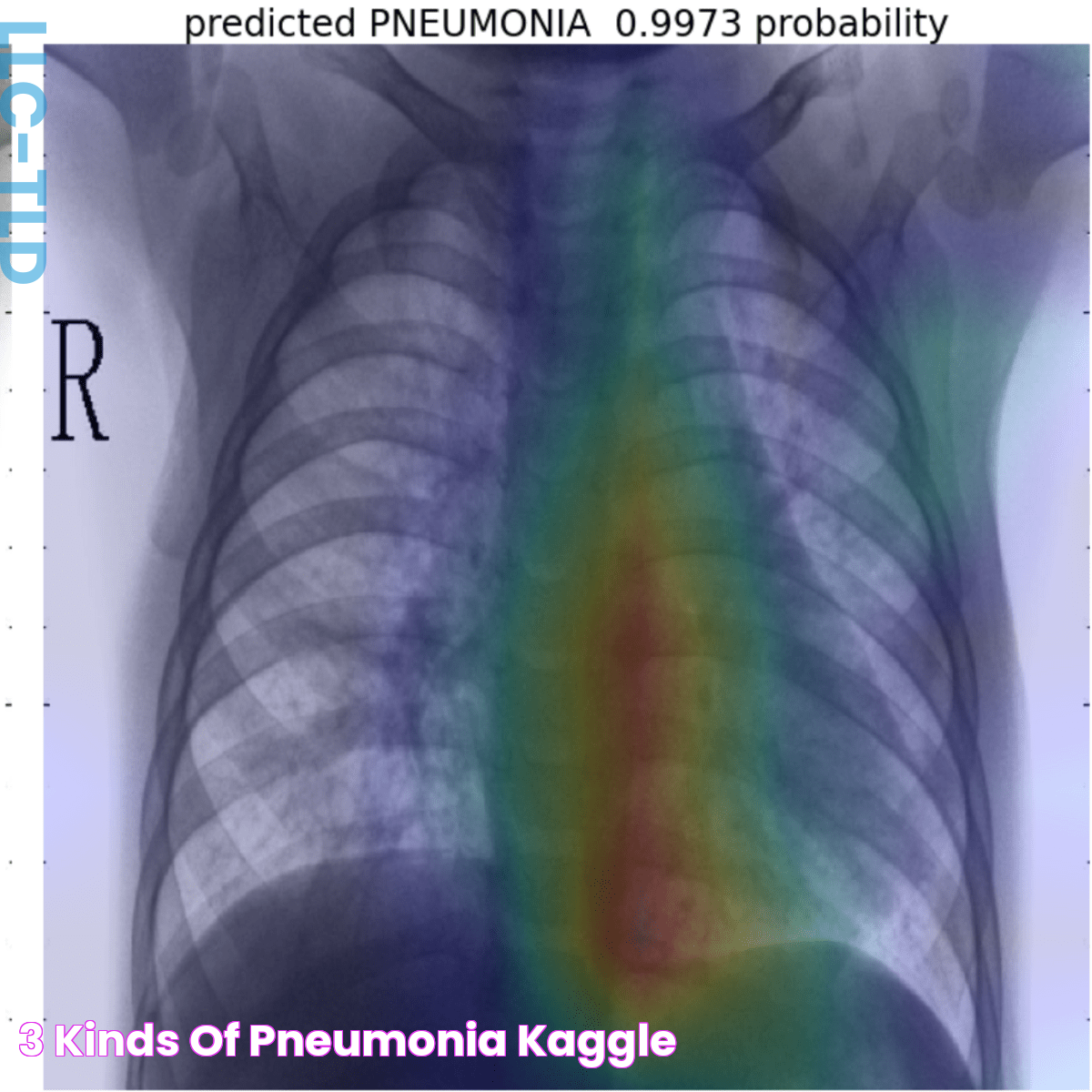 3 kinds of Pneumonia Kaggle