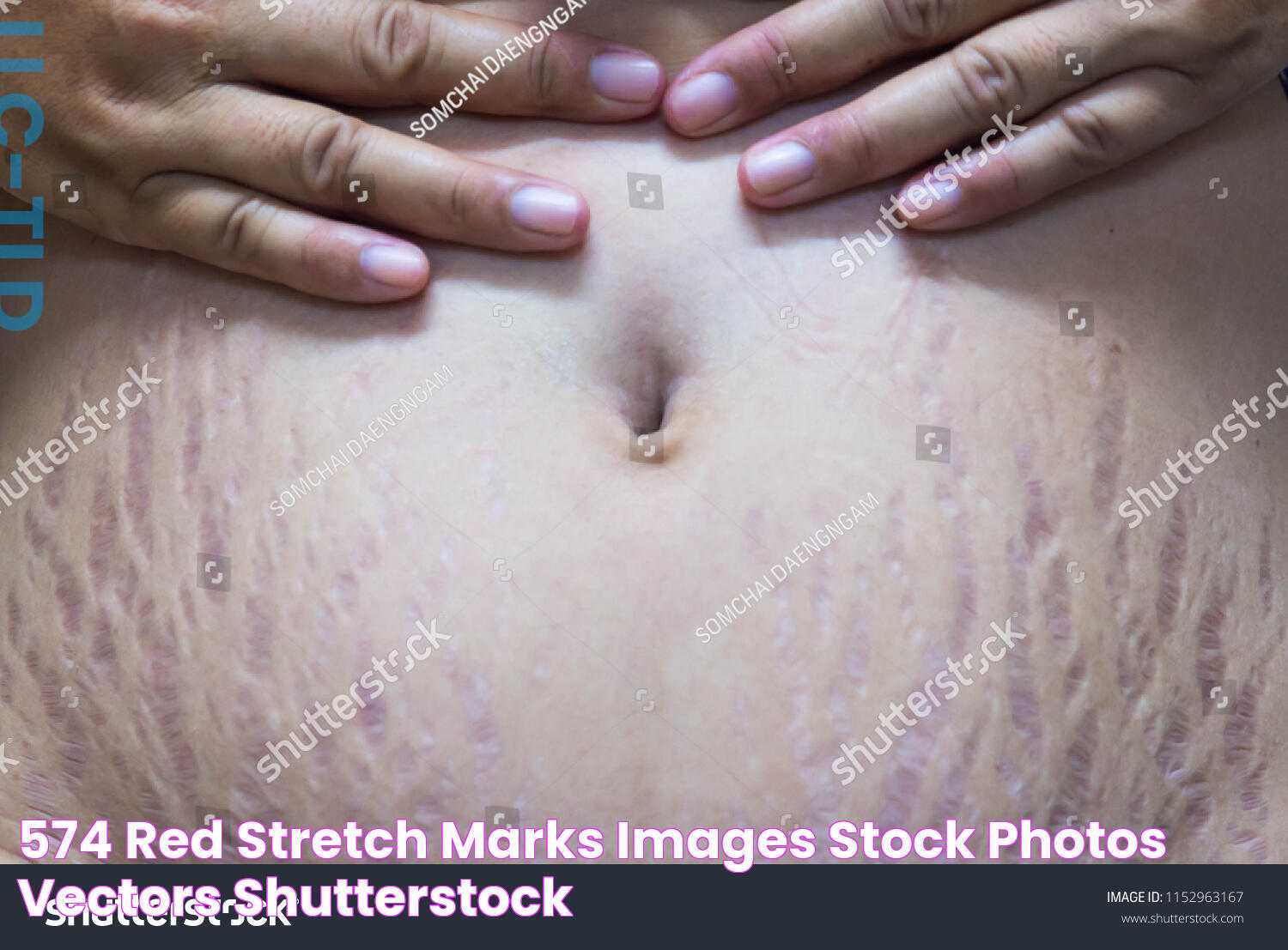 574 Red stretch marks Images, Stock Photos & Vectors Shutterstock