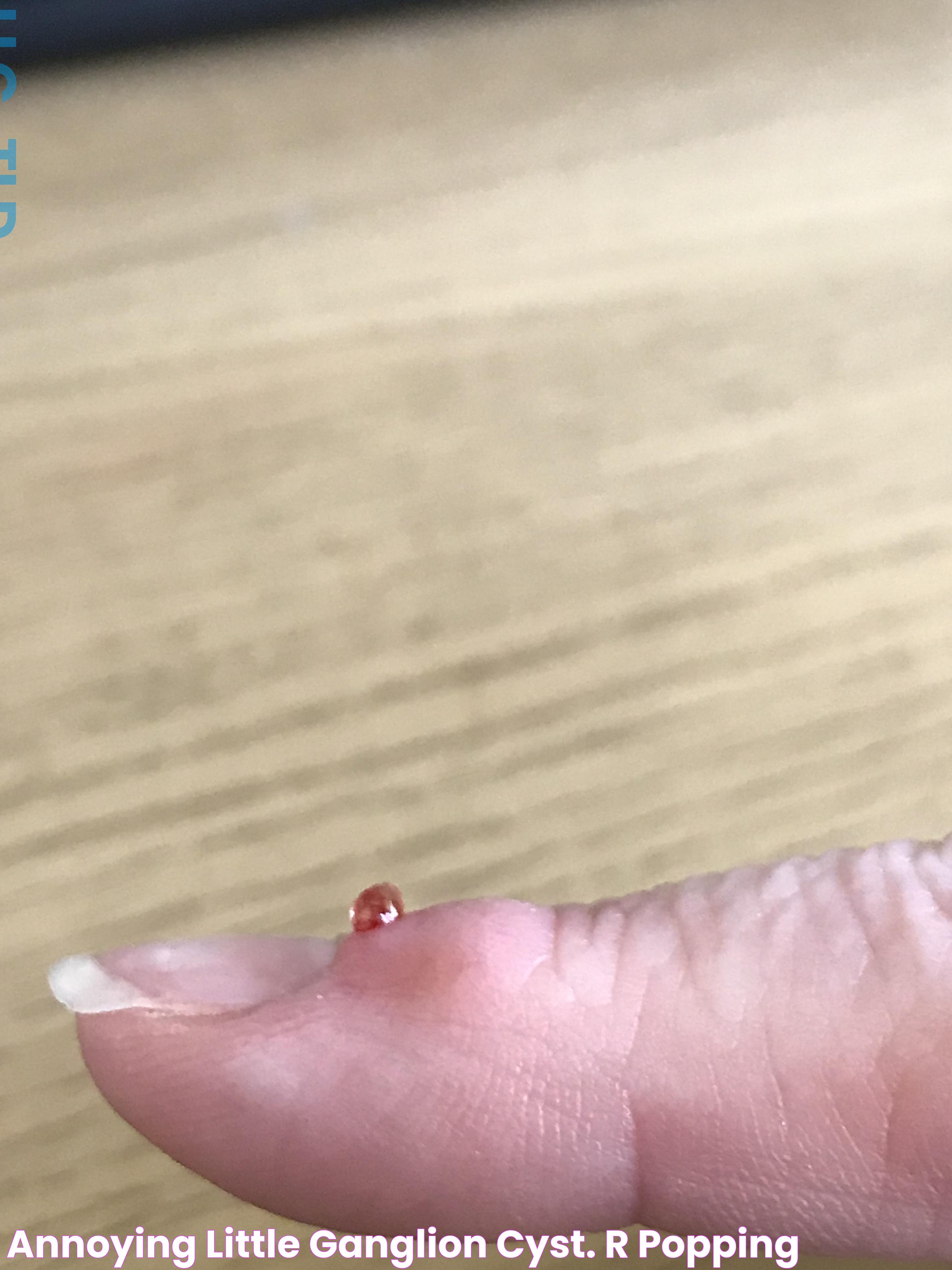 Annoying little ganglion cyst. r/popping