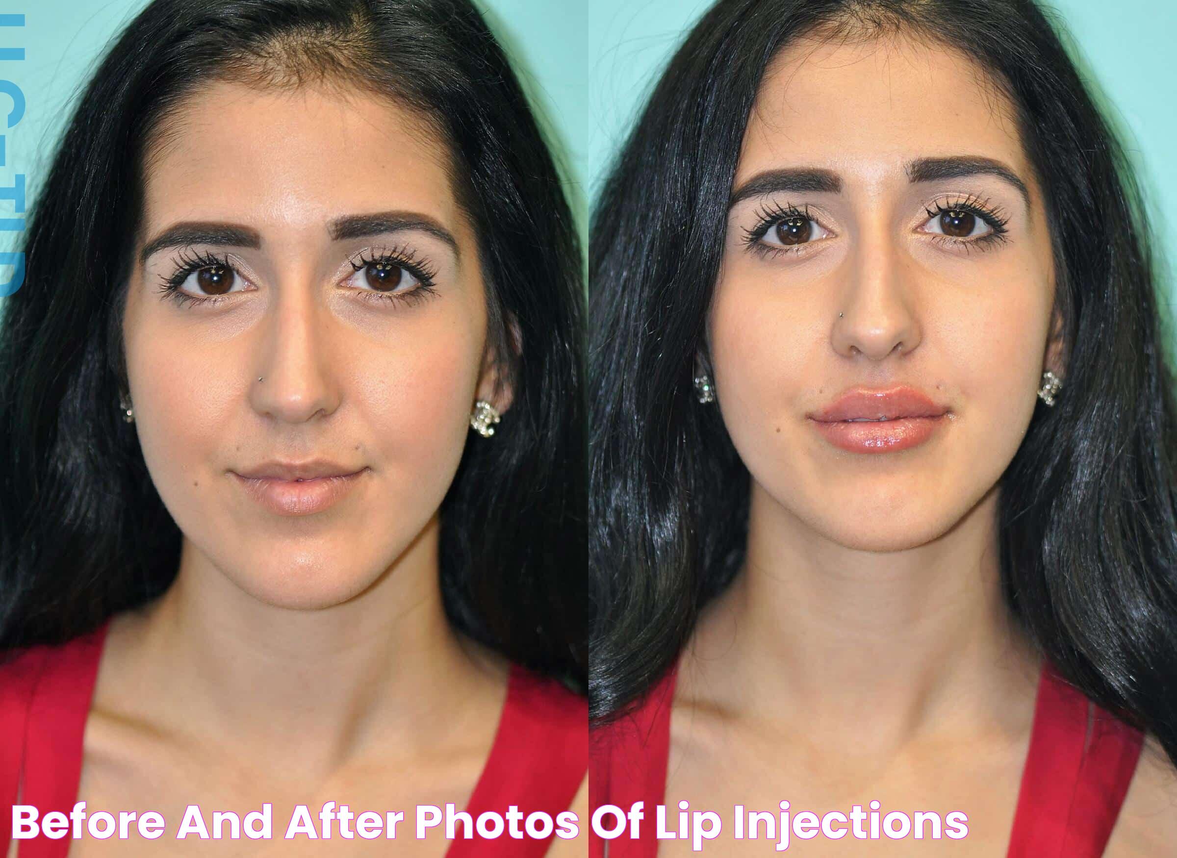 Before And After Photos Of Lip Injections