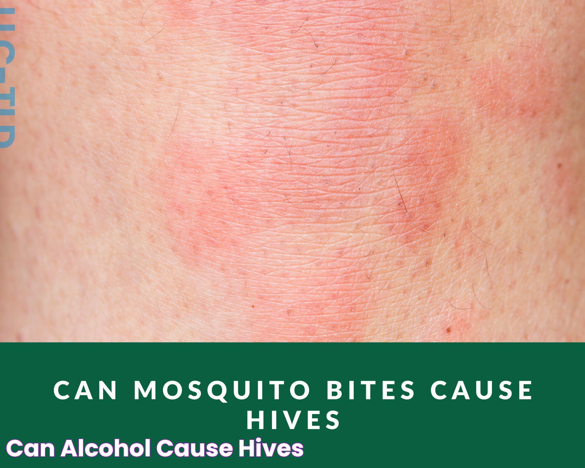 Can Alcohol Cause Hives?