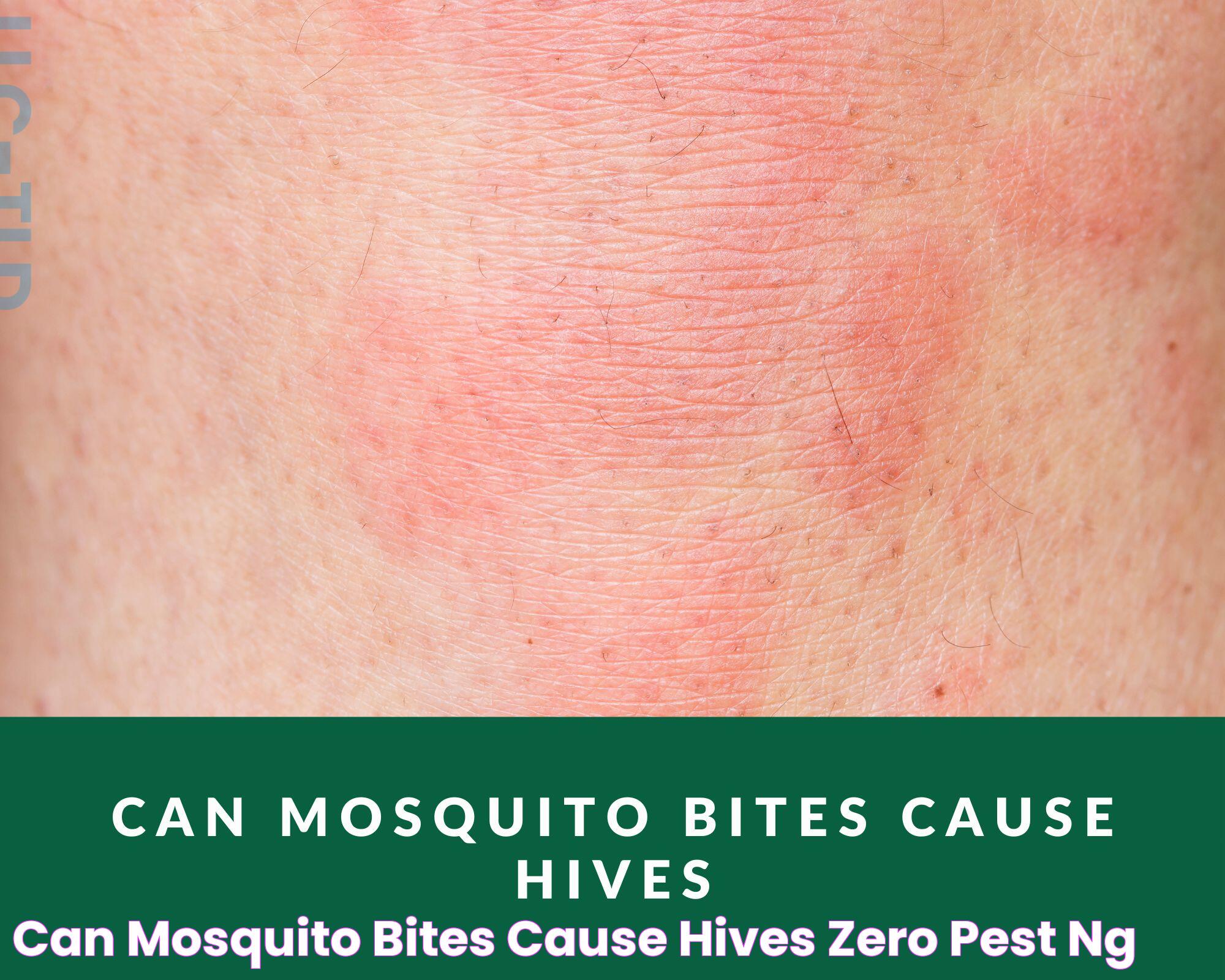 Can Mosquito Bites Cause Hives Zero Pest NG