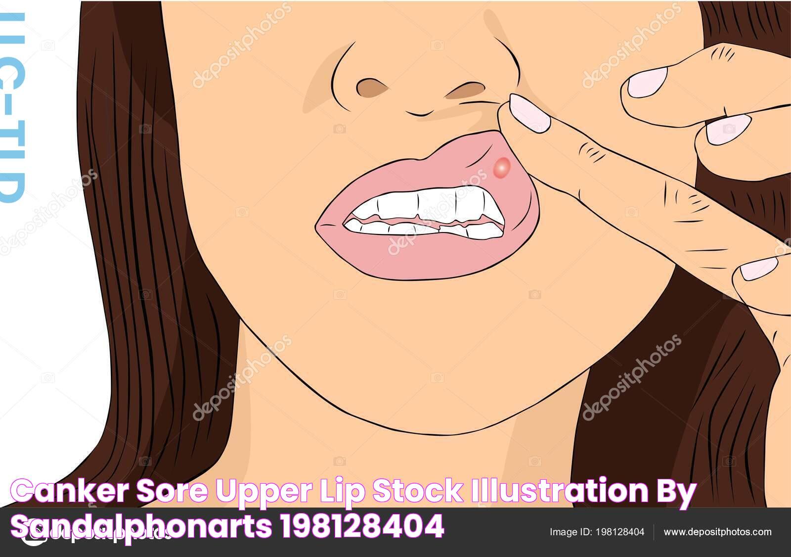 Canker Sore Upper Lip Stock Illustration by ©Sandalphonarts 198128404