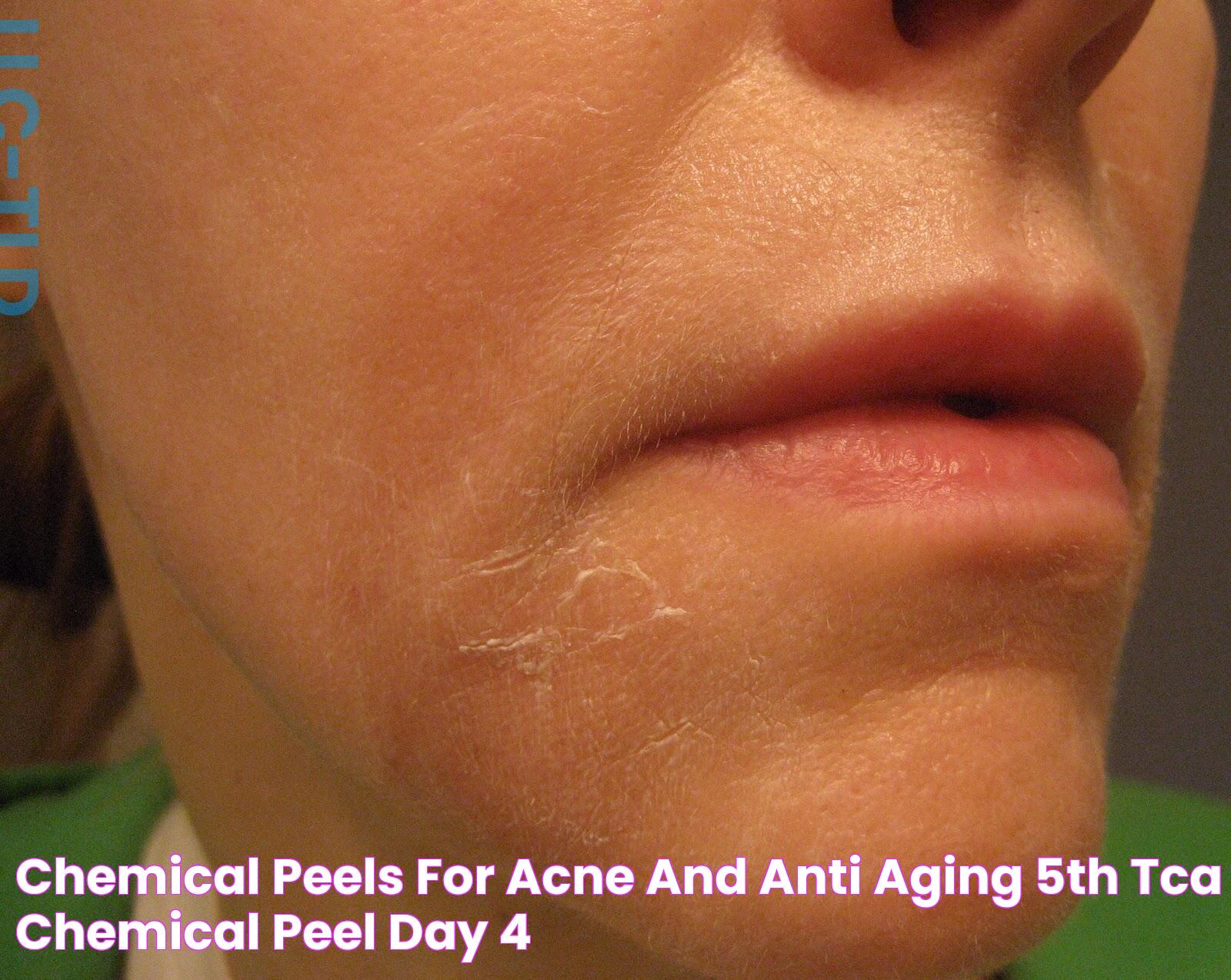 Chemical Peels for Acne and Anti Aging 5th TCA Chemical Peel day 4