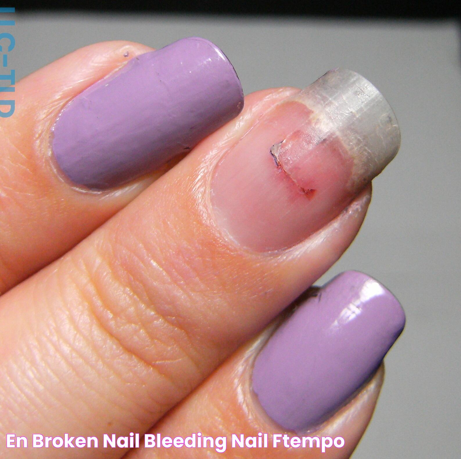 En Broken Nail Bleeding Nail Ftempo