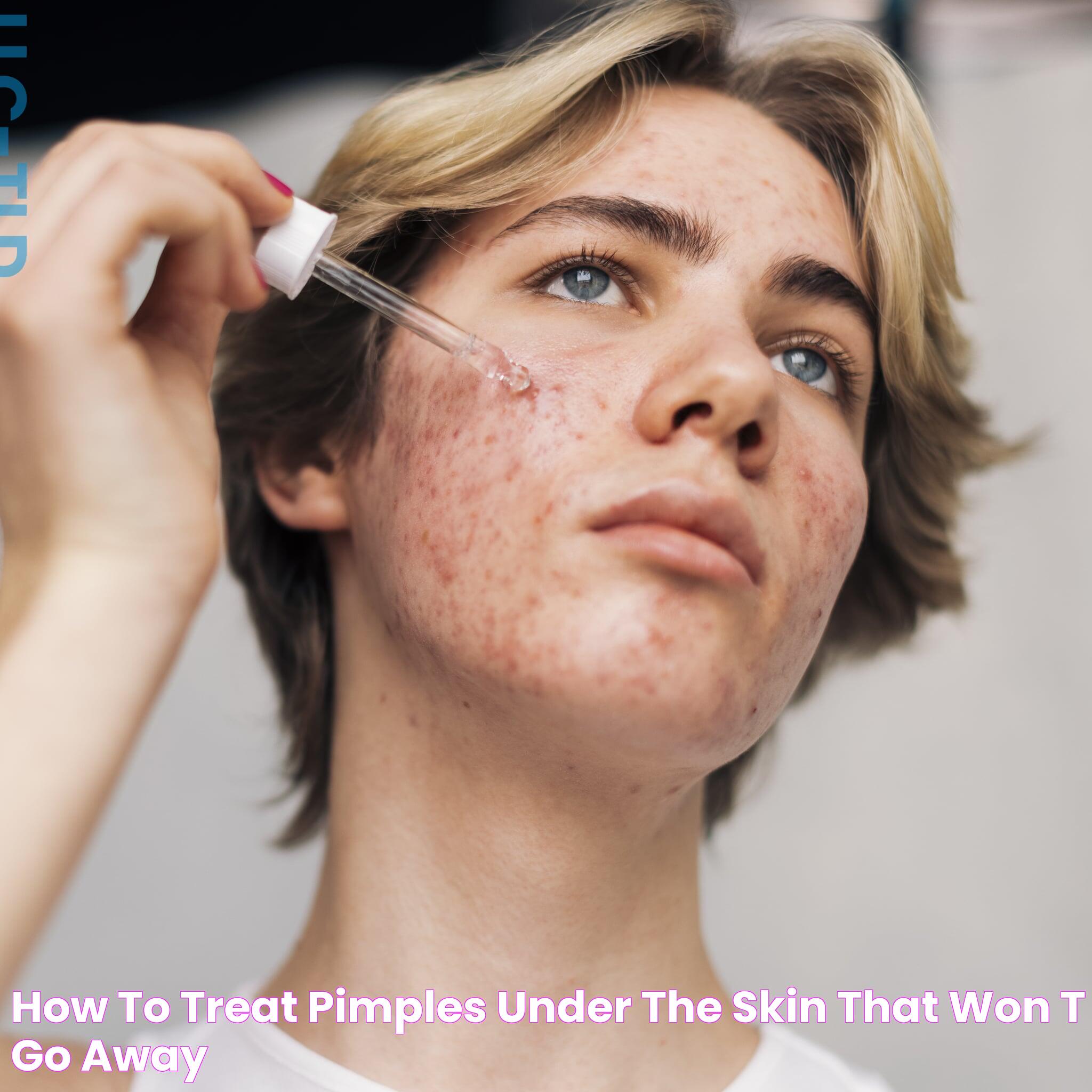 How to Treat Pimples Under the Skin That Won't Go Away