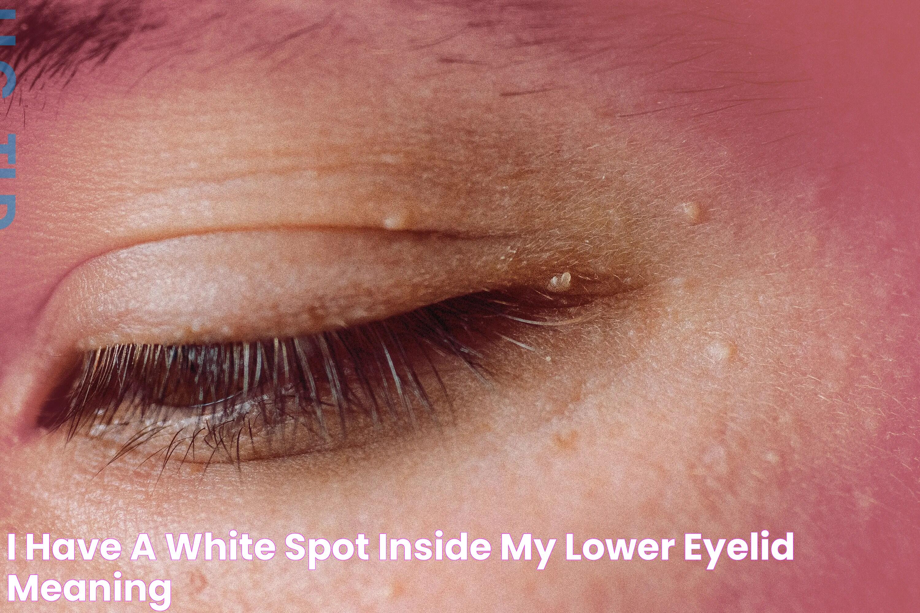 I Have A White Spot Inside My Lower Eyelid Meaning