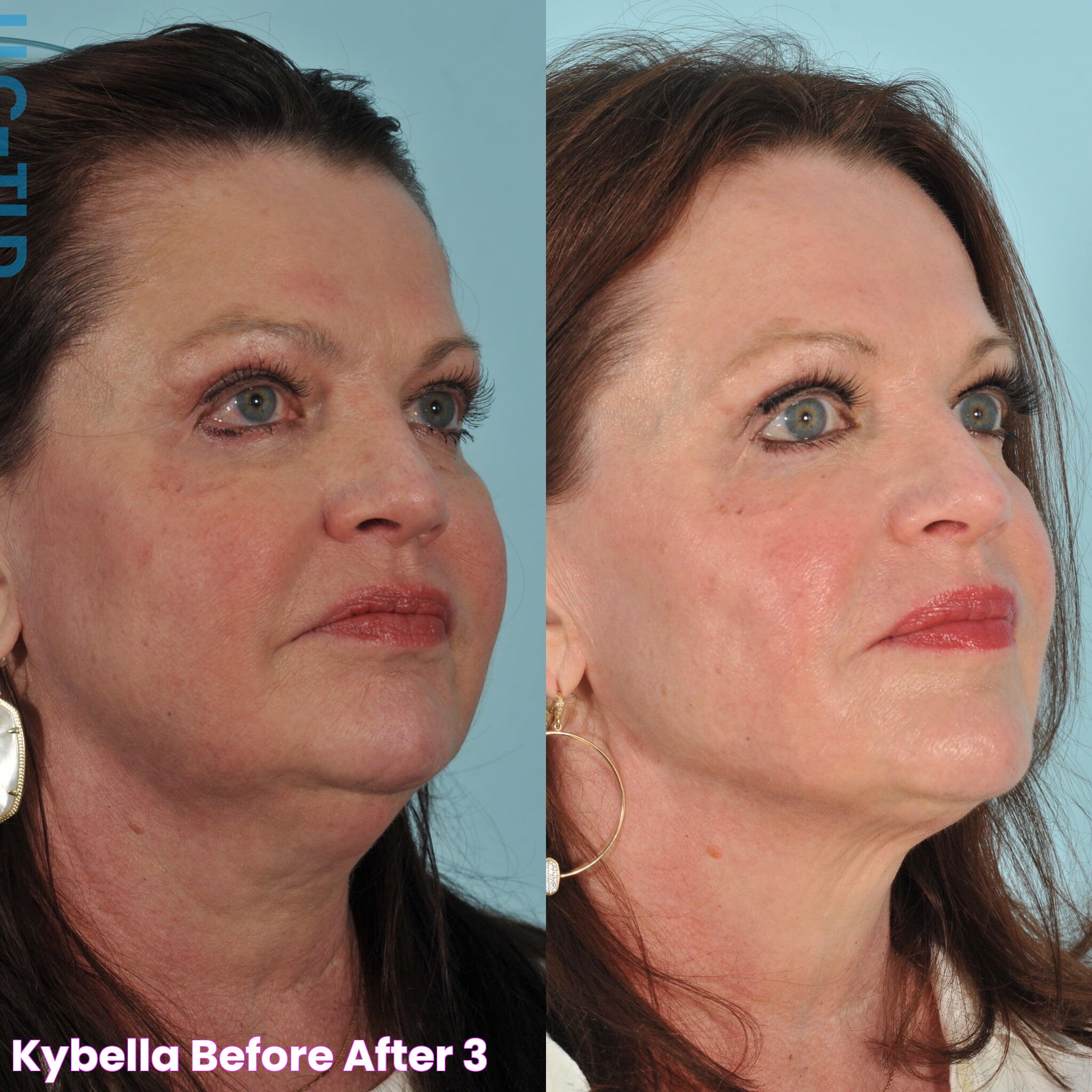 Kybella Before & After 3