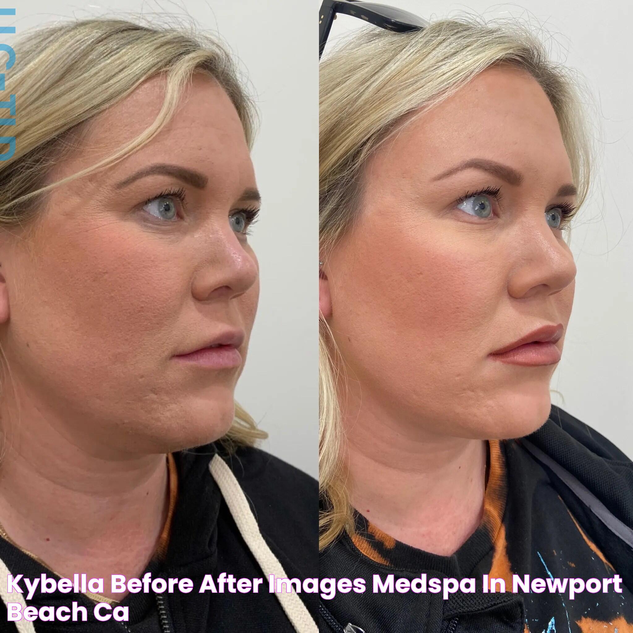 Kybella Before & After Images Medspa in Newport Beach, CA