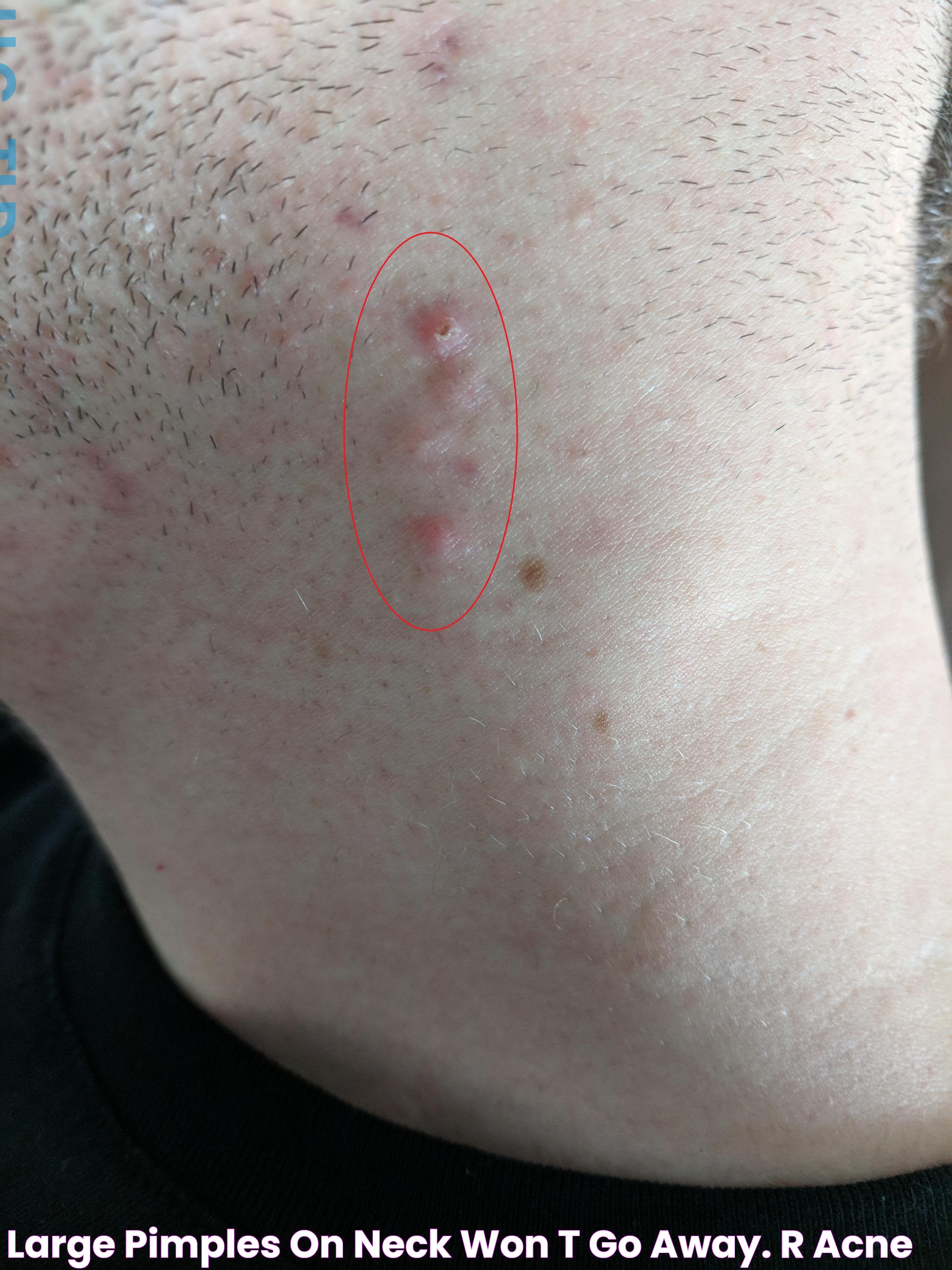 Large pimples(?) on neck won't go away. r/acne