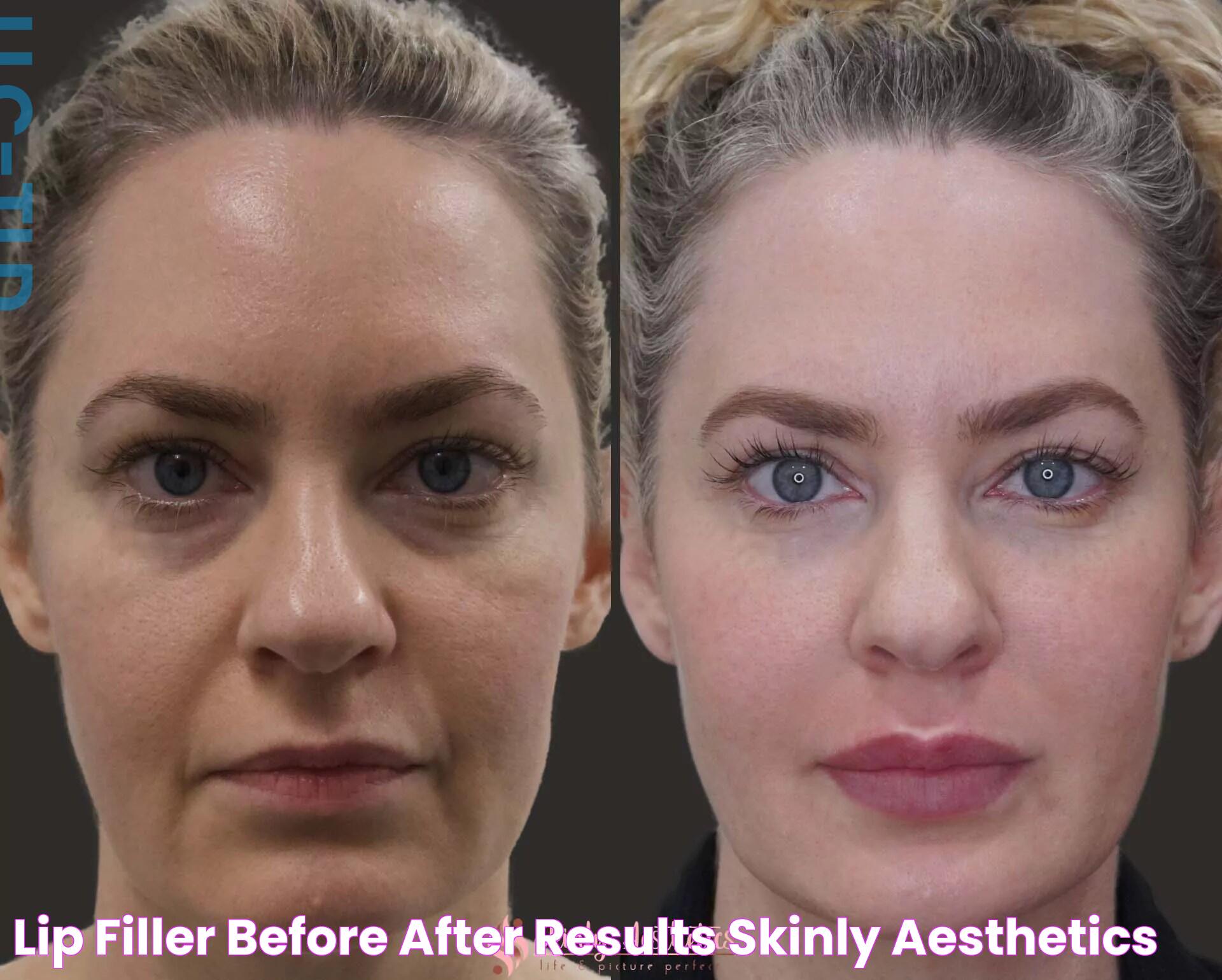 Lip Filler Before & After Results Skinly Aesthetics