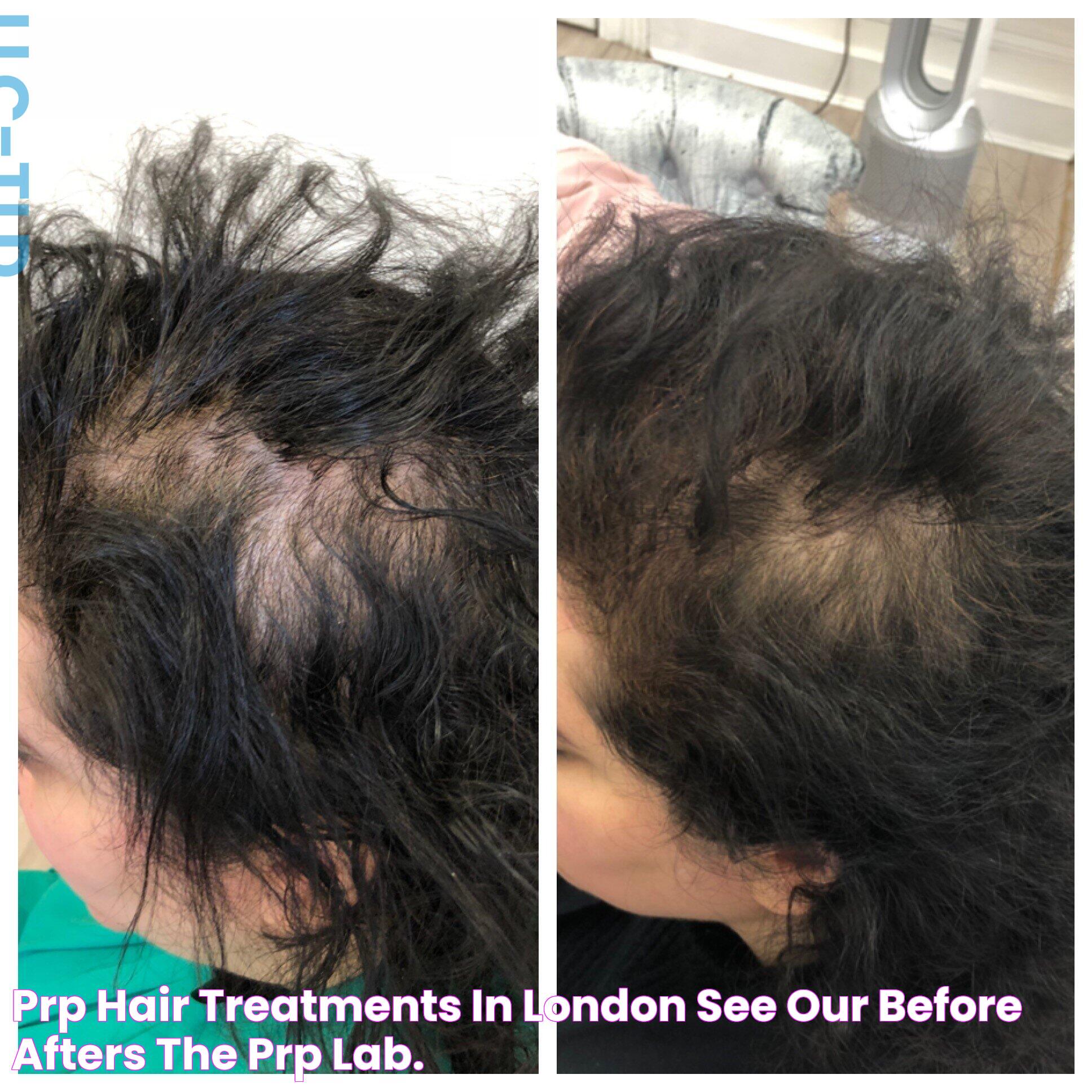 PRP Hair Treatments In London See Our Before & Afters — The PRP Lab.