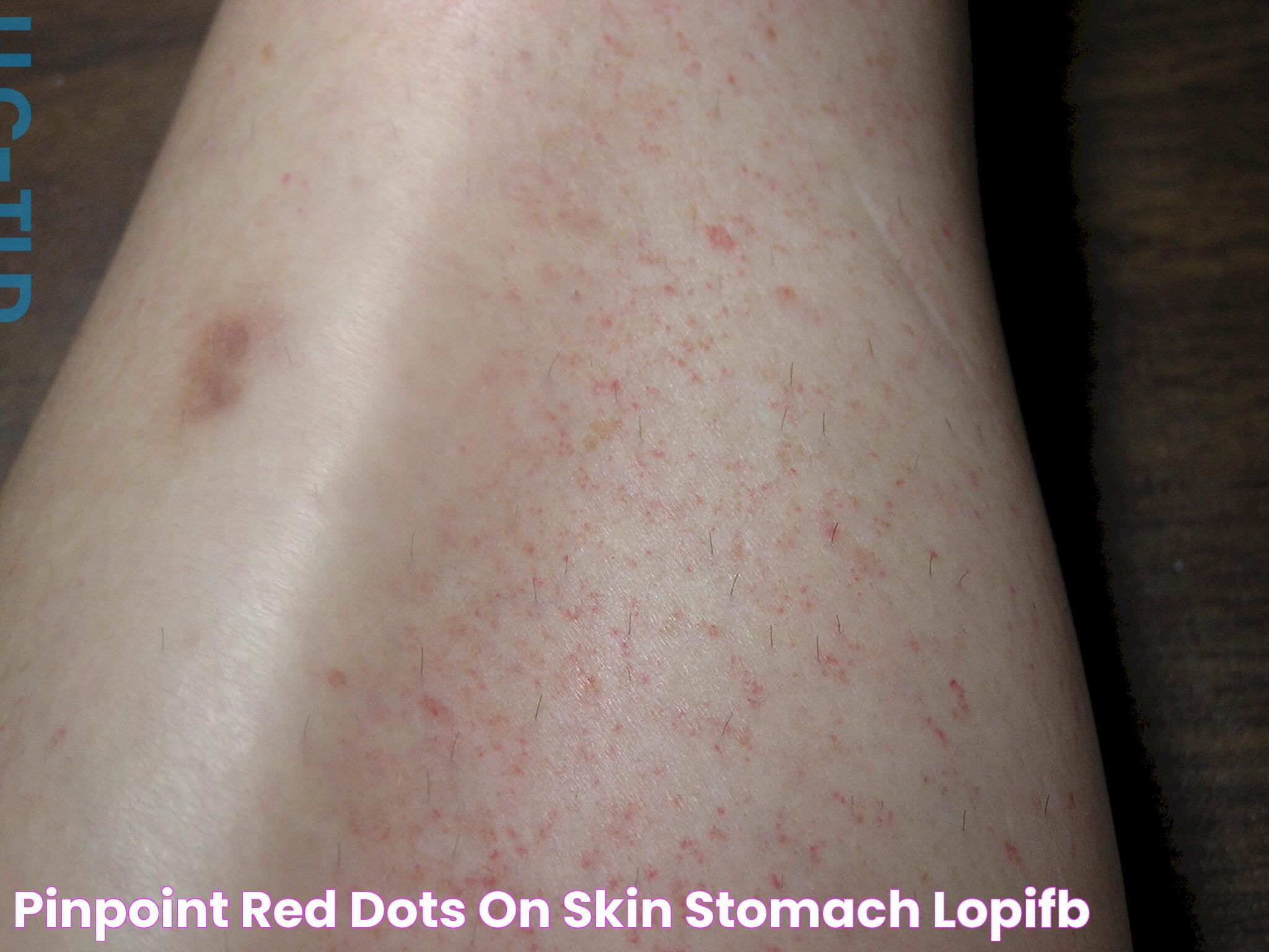 Pinpoint red dots on skin stomach lopifb