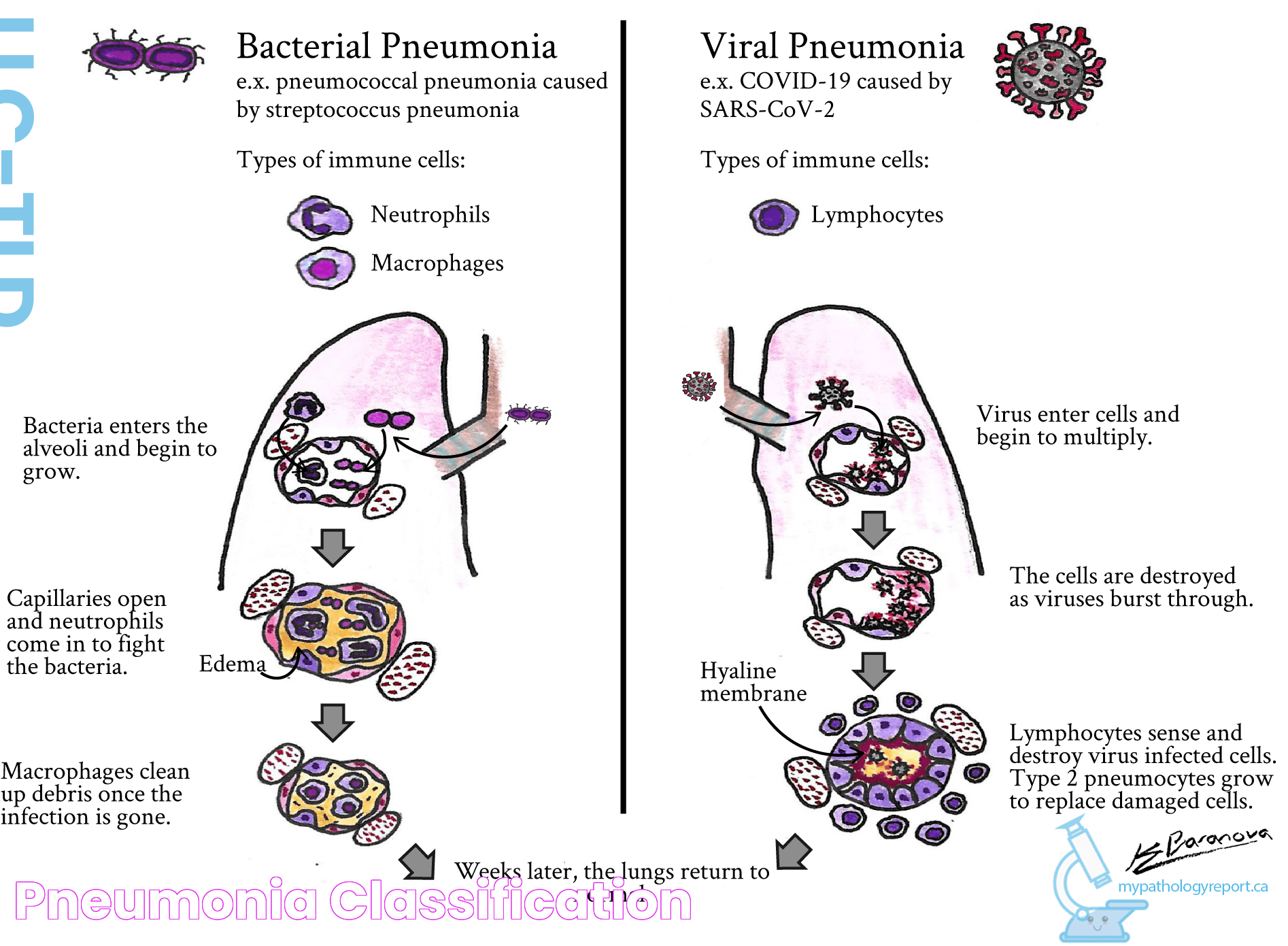 Pneumonia Classification