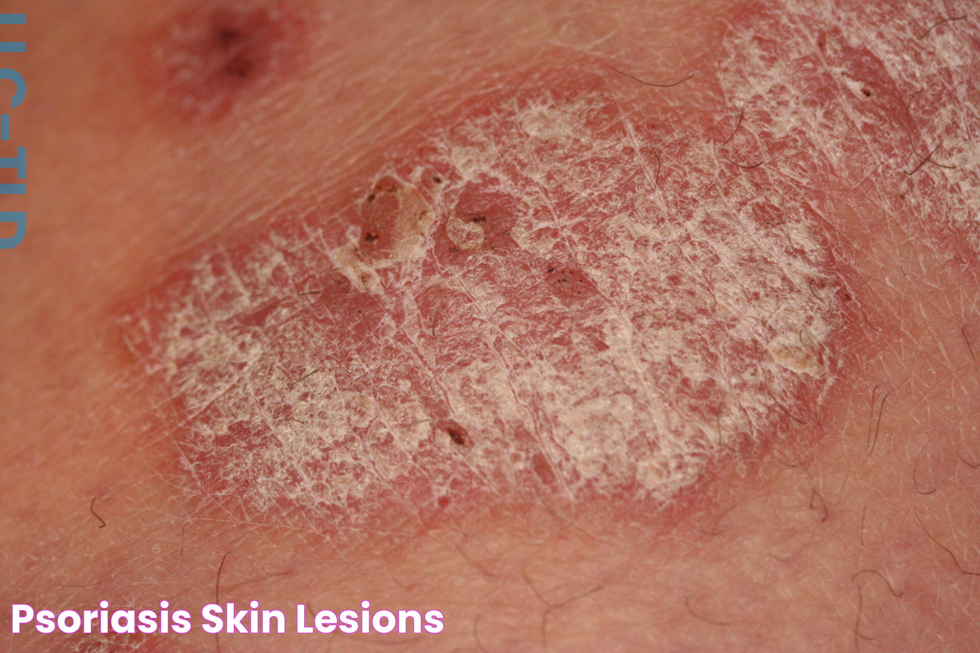 Psoriasis Skin Lesions