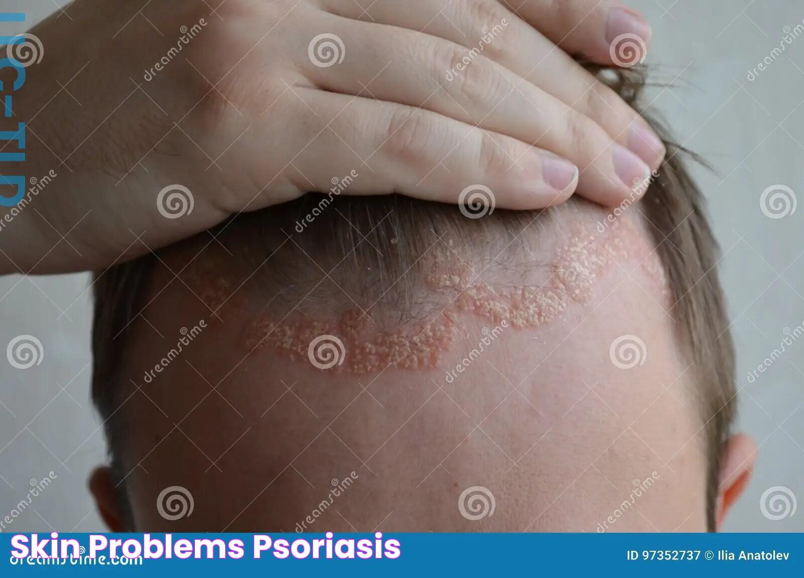 Skin Problems Psoriasis