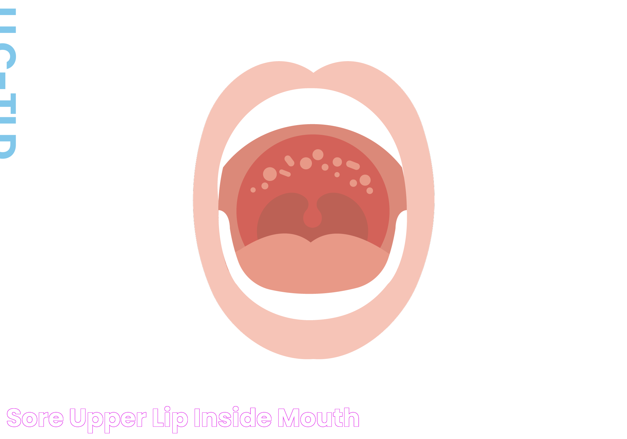 Sore Upper Lip Inside Mouth