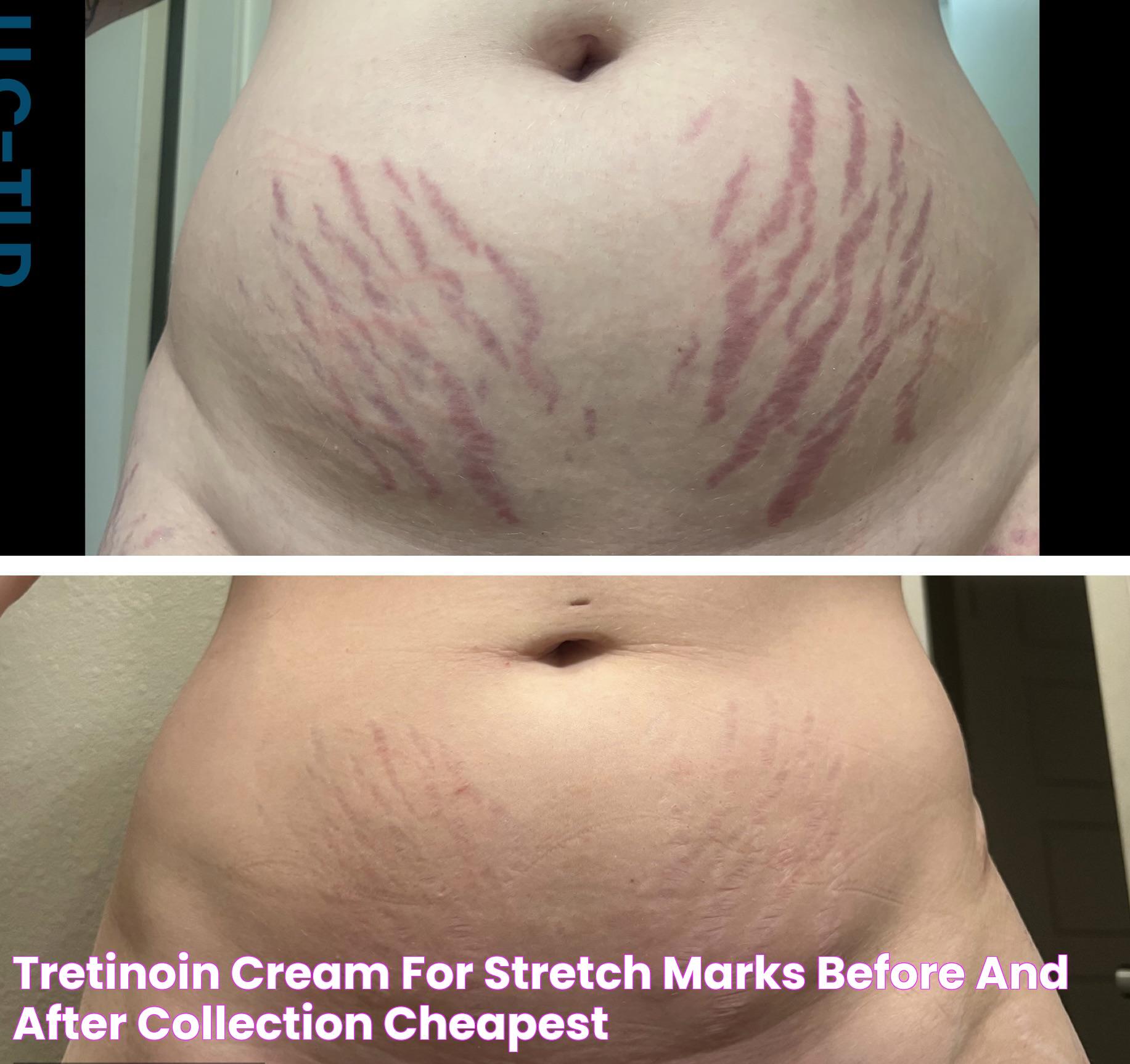 Tretinoin Cream For Stretch Marks Before And After Collection Cheapest