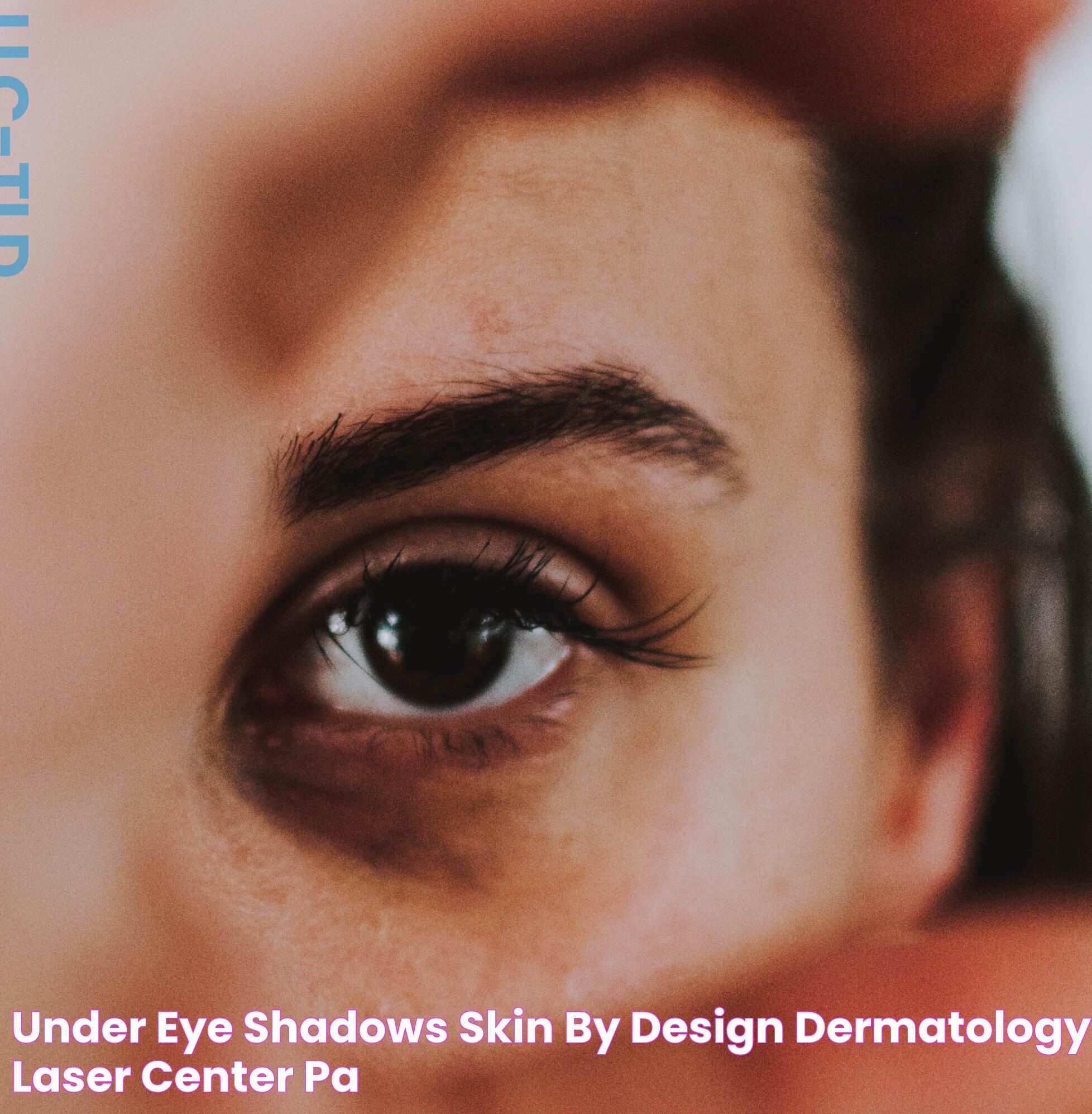 Under Eye Shadows Skin by Design Dermatology & Laser Center, PA