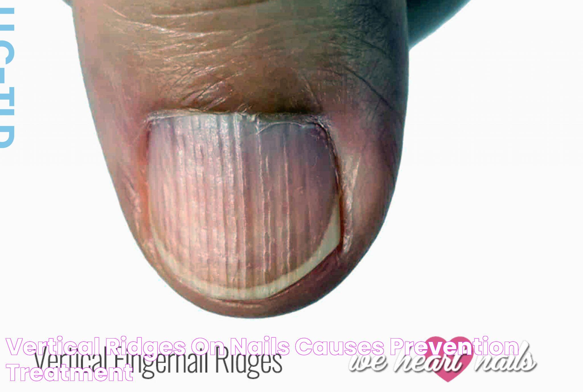 Vertical Ridges on Nails Causes, Prevention & Treatment