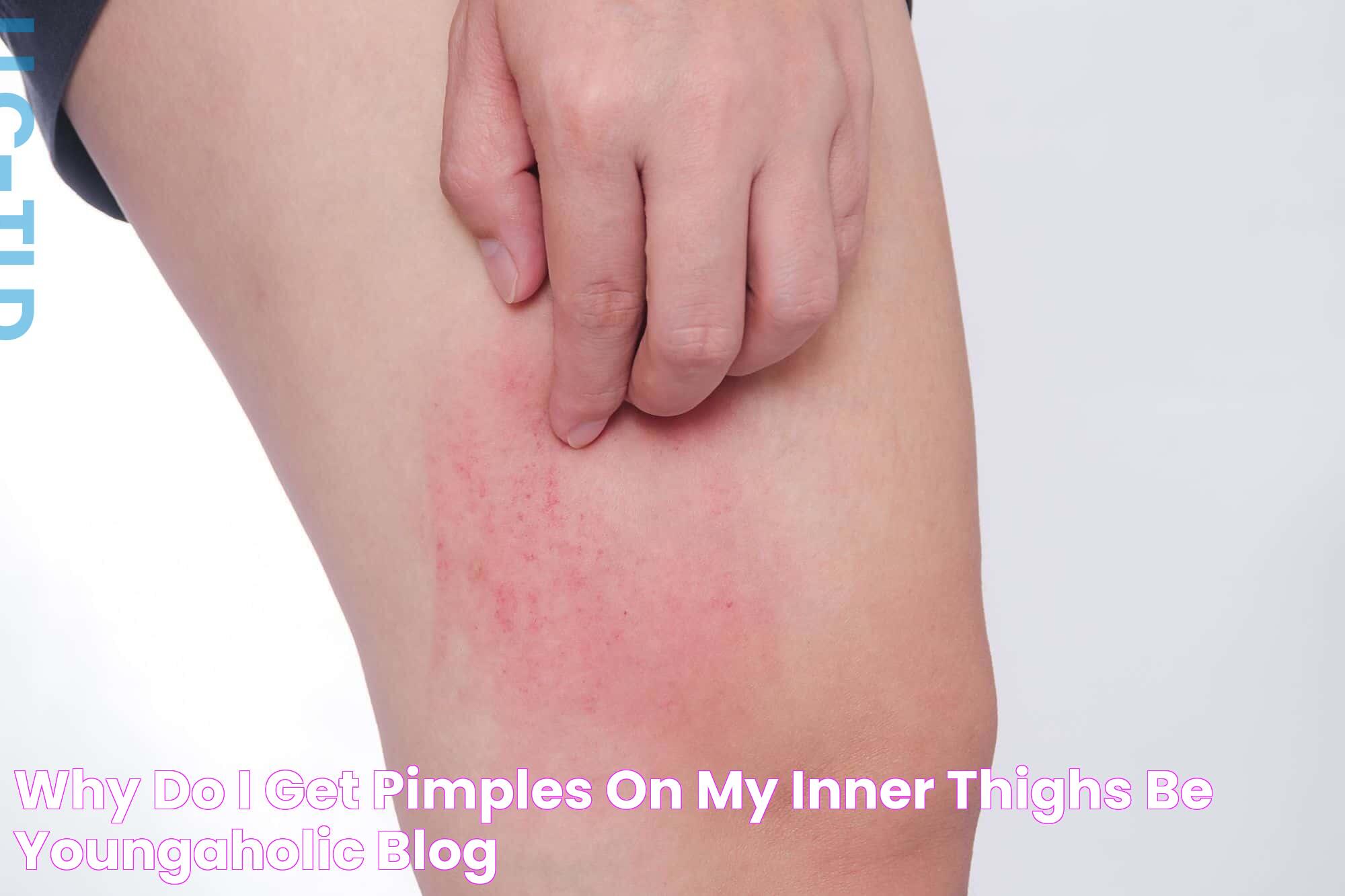 Why Do I Get Pimples on My Inner Thighs? Be Youngaholic Blog