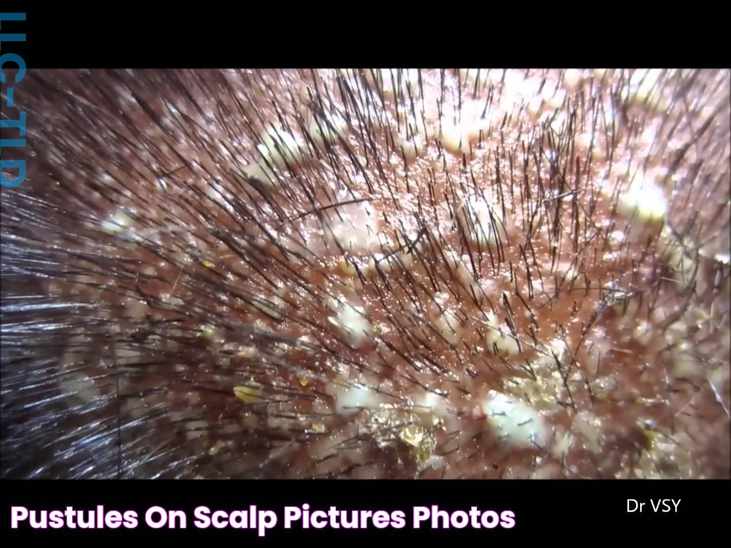 pustules on scalp pictures, photos